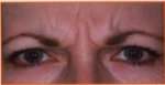Botox Cosmetic - BEFORE