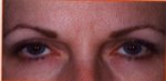 Botox Cosmetic - AFTER