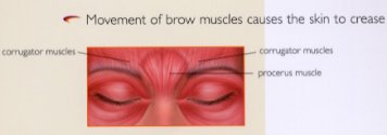 Botox Cosmetic - Condition Treated