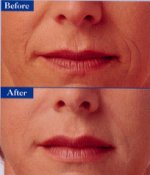 Collegen Treatment for Fine Lines and Wrinkle - BEFORE & AFTER