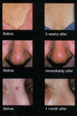 DioLite Laser Pigmented and Vascular (Spider Vein) Lesion Removal - BEFORE & AFTER