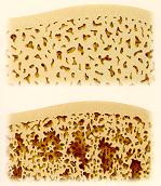 Normal vs. Osteoporotic Bone
