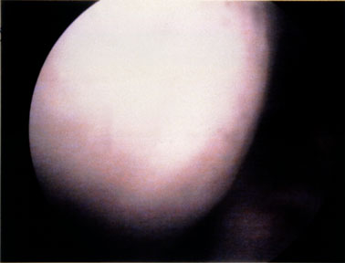 healthy articular cartilage