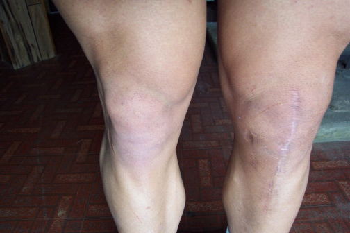both legs