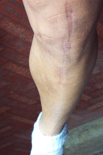 left leg #1