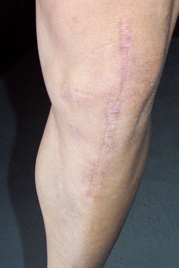 left leg #2
