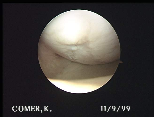 damaged articular cartilage